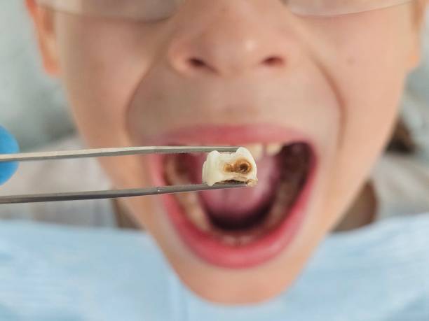 Best Urgent Care for Lost Fillings or Crowns in Redding, CA